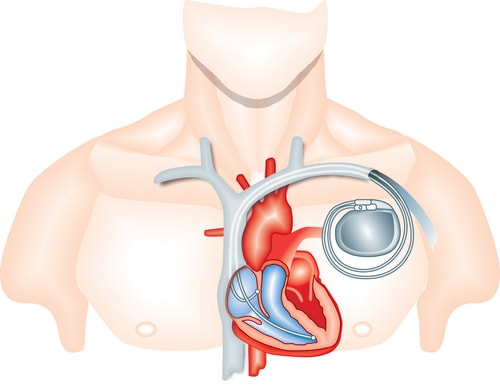 protecting your pacemaker from hackers